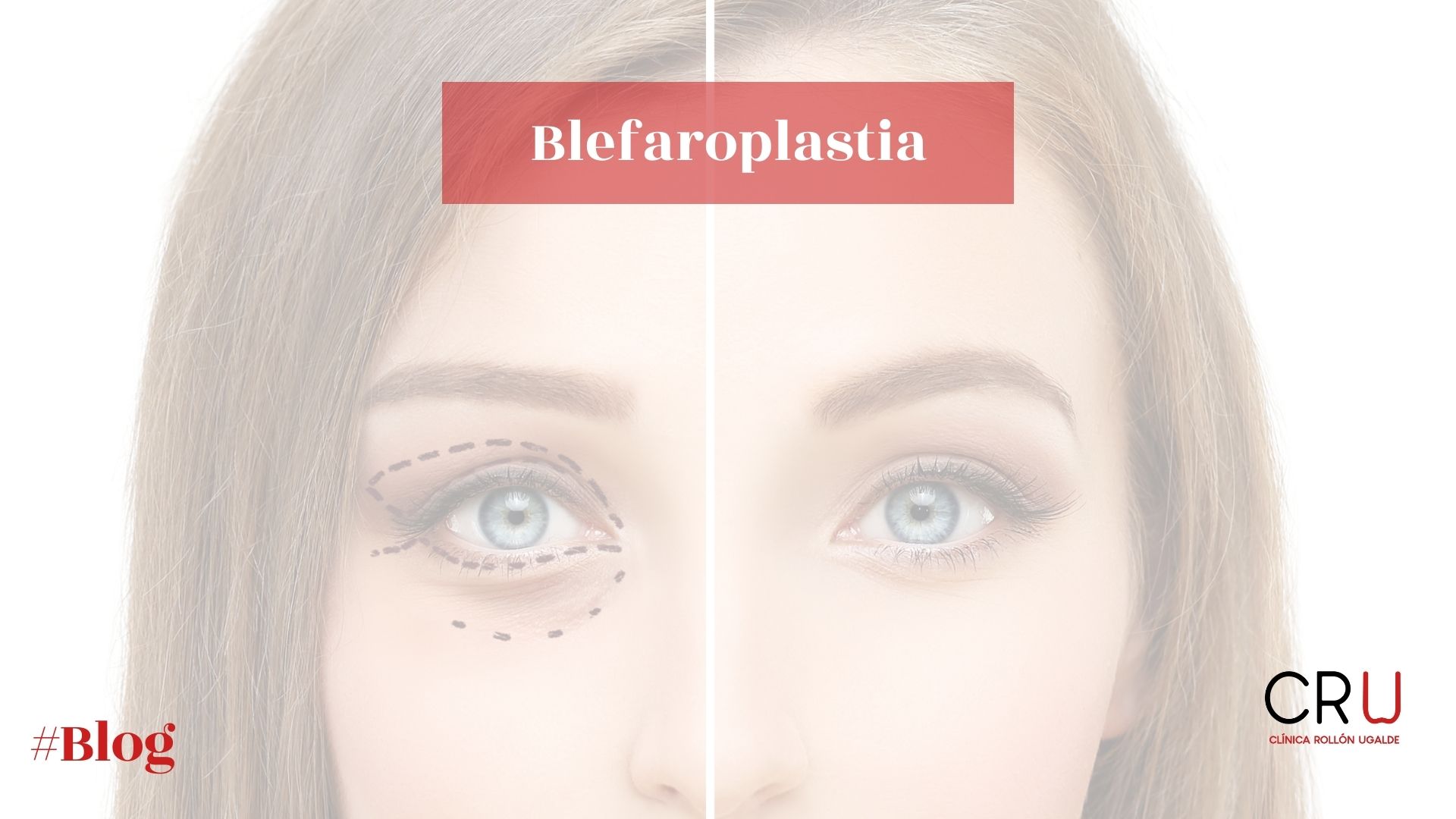 ¿Qué es la blefaroplastia? - Clinica Rollon Ugalde